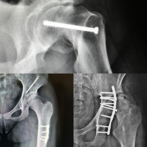 Quais os riscos de uma cirurgia no quadril?